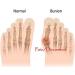 Hallux Valgus Correction Elbow Malalignment - Gel Hallux Valgus Bandage & Toe Spreader Sleeves for Pain Relief - Buy Online on GoSupps.com