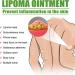YSGBYSG LipomaCure Ointment 20g - 5PCS | Lump-Free Lipoma Removal Cream for Skin Anti-Swelling - Buy Online on GoSupps.com