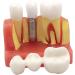 4x Dental Implant Teeth Model with Removable Crown - Crown & Bridge Dentist Training Tool for Patient Analysis | International Shipping - Buy Online on GoSupps.com