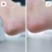 Buy Pedivac Electric Corn Removal Tool | Rechargeable Foot Care Device with 2 Attachments - Perfect Pedicure Solution | International Shipping Available - Buy Online on GoSupps.com