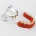 Dental Restore Model with 4 implants implant Demonstration Lower Precision Model Dental Teeth Restoration semi-Covered Prosthesis Decoration