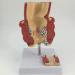 Pathological Hemorrhoids - Injury Model of Hemorrhoids Colorectal - Placed On Base - The Best Educational Support for Communication - Buy Online on GoSupps.com