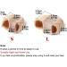 Toe Spacer Gel Separators Bunion Corrector for Overlapping Toe - Pain Relief (2pcs) - Buy Online on GoSupps.com