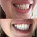 ICY Bear Dental Teeth Whitening Gel Refills Teeth Whitening Gel Syringes High Concentration Pap Up to 10 Shades Whiter Vegan & Non-GMO - Buy Online on GoSupps.com