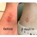 Sialicess Reusable Silicone Scar Strips for Keloid & Hypertrophic Scars - 2 Month Supply - 4 PCS - Buy Online on GoSupps.com