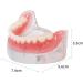 COMDS Dental Implant Model & Removable Dentures for Educational Use | 4 Nail Implant Demo Models - Buy Online on GoSupps.com