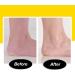 PediVac Electric Callus Remover with Built-In Vacuum - New Look | Removes Calluses & Dry Skin in Seconds | Mess-Free | 2000 RPMs | LED Light | 2 Speed Settings - Buy Online on GoSupps.com