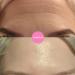 Notox Forehead + Frown Lines - Nudie Face - 100% Medical Grade Silicone Wrinkle Patch - Reusable Silicone Face Patch To Reduce Fine Lines and Wrinkles - Wrinkle Smoothing - Fast Results - Buy Online on GoSupps.com
