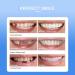 Snap On Veneers for Men & Women | Moldable False Teeth & Denture Replacement Kit with Teeth Grinding Guard & Whitening Strips - Buy Online on GoSupps.com