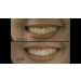 Dr. George's Dental White Whitening Kit for Two - Professional Teeth Whitening Treatment - Buy Online on GoSupps.com