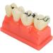 Ververt Touch Tooth Model - 180mm Dental Caries Demonstration Model for Schools & Dentists | Learning Aid for Dental Lessons - Buy Online on GoSupps.com