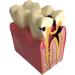 Colcolo Teeth Model - 6X Caries Comparison Examination Models for Study & Research | International Shipping Available - Buy Online on GoSupps.com