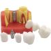 4x Dental Implant Teeth Model with Removable Crown - Crown & Bridge Dentist Training Tool for Patient Analysis | International Shipping - Buy Online on GoSupps.com