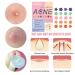 110 Acne Patches with Salicylic Acid & Tea Tree Oil - Transparent Pimple Stickers for Clear Skin | Cute Blemish Dots for Face - Buy Online on GoSupps.com