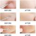 KAV Comedone Extractor Kit 5-Piece Blackhead Remover Tool Set with Storage Case for Acne Prone Skin - Stainless Steel Pimple and Blemish Extractor Tools for Deep Cleansing - Buy Online on GoSupps.com
