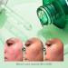 Tea Tree Oil for Face - Acne Serum & Blemish Spot Treatment - Unclogs Pores Soothes Breakouts - 1 fl oz for Smooth Glowing Skin - Buy Online on GoSupps.com