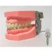 Ernzi Removable Dentures Model - Ideal Typodont for Dental Practice & Study Lessons - Buy Online on GoSupps.com
