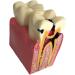 Colcolo Teeth Model - 6X Caries Comparison Examination Models for Study & Research | International Shipping Available - Buy Online on GoSupps.com