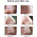 Benkeg Blackhead Remover - Electric Blackhead Suction Device with 5 in 1 Pimple Zit Comedone Extractor Tool Acne Removal kit Blackhead Remover Household Face Pore Cleaner Cosmetic Instrument White with 5pcs needles - Buy Online on GoSupps.com