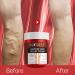 Varicose Vein Relief Cream Set - Auquest Treatment for Legs with Patches - Spider Veins Repair - Buy Online on GoSupps.com