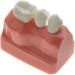 Samnuerly Dental Implant Model - 4-Way Analysis & Crown Bridge Demo for Training | International Shipping Available - Buy Online on GoSupps.com