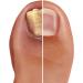 Pronail Plus Fungal Nail Solution 10 ml Brush Application - Buy Online on GoSupps.com