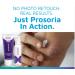Prosoria Treatment System Double Kit 2oz | Powerful Psoriasis Relief with Salicylic Acid Turmeric Shea Butter & Vitamins | Gel & Ointment for Scaling Flaking Dryness Itching & Redness Relief Treatment Kit 4 Ounce - Buy Online on GoSupps.com