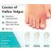 Toe Separator for Feet Toe Spacers Correct Toes Yoga Silicone Hammer Toe Corrector for Women & Men Correct Toe Straighteners for Overlapping Toes (All Finger Toe Separator) - Buy Online on GoSupps.com