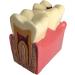 Colcolo Teeth Model - 6X Caries Comparison Examination Models for Study & Research | International Shipping Available - Buy Online on GoSupps.com