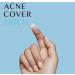 Buy Acne Pimple Healing Patch | Fast Results & Clear Impurities | Skin Perfecting Solution - International Shipping - Buy Online on GoSupps.com