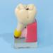 Dytah Dental Implant Model - Tooth Pathology & Crown Bridge Demonstration | Parodontal Sortal Teeth & Gums Educative Model for Dental Care - Buy Online on GoSupps.com