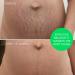 MULTI-AWARD-WINNING Stretch Marks Removal for Men & Women Peptide and Vitamins Stretch Mark & Scar Cream for Reduction in Stretch Marks Improves Elasticity and Firmness Perfect Pregnancy Gift STRETCH MARKS REMOVAL CREAM - Buy Online on GoSupps.com
