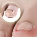 HEALLILY Ingrown Toenail Tool Toenail Corrector Patch Paronychia Toenail Treatment Tape Toenail Correction Sticker Paronychia Recover Foot Care Tool 3 Pairs - Buy Online on GoSupps.com