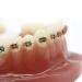 Dental Teeth Orthodontic Model - Study Tool for Teaching with Metal Bracket | International Shipping Available - Buy Online on GoSupps.com