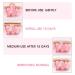 Hernia Belt Baby 2pcs Hernia Belt Hernia Treatment Children Infant Baby Umbilical Hernia Belt() Pink - Buy Online on GoSupps.com
