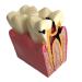 Colcolo Teeth Model 6 Times Caries Compare Examination Models Study And Research