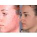 Anti Acne Chemical Peel Kit - BHA Acne Treatment with Acid Neutralizer for Clear Skin - 1.69oz - Buy Online on GoSupps.com