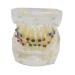 Dental Orthodontic Model Oral Cluttered Teeth Pattern with Ceramic Supports for Studying The Anti-jaw Protrusion Opening of The jaw