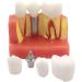 4x Dental Implant Teeth Model with Removable Crown - Crown & Bridge Dentist Training Tool for Patient Analysis | International Shipping - Buy Online on GoSupps.com