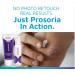 Prosoria Psoriasis Treatment System - Clinical Strength with Natural Botanicals | Soften, Restore & Treat Skin | 2 Fl Oz (Pack of 2) - Buy Online on GoSupps.com