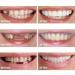 Instant Smile Teeth Veneers - Fake Dentures Socket for Women and Men - 2pcs Dental Veneers for Temporary Tooth Repair - Buy Online on GoSupps.com