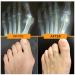 Buy Bunion Splint & Orthopedic Corrector | Adjustable Big Toe Straightener for Men & Women - International Shipping - Buy Online on GoSupps.com
