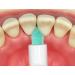 Apa Care Sonic Inter Polish Toothbrush Heads Set of 2 - Perfect for Interdental Spaces | ApaCare Sonic Professional - Buy Online on GoSupps.com