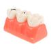 Ultechnovo Recovery tool Ser from 2 caries tooth teeth model study caries tooth teaching tools demonstration teeth model model disease teeth hotfix tool 12.5x7x6.5cmx2pcs such as shown