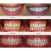 Triwhite Vegan Teeth Whitening 22% CP Refill Gel - No Sensitivity - 10ml - Buy Online on GoSupps.com