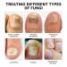Furzero Purenail Laser Therapy Device | Effective Nail Fungus Treatment & Light Therapy for Healthy Nails - Buy Online on GoSupps.com