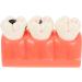 Ultechnovo Dental Recovery Tool Set - 2 Caries Tooth Models for Teaching & Demonstration | 12.5x7x6.5cm - Ideal for Dentistry Education - Buy Online on GoSupps.com