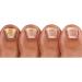 Pronail Plus Fungal Nail Solution 10 ml Brush Application - Buy Online on GoSupps.com