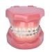 Dytah 1: 1 demonstration orthodontic treatment teeth model patient communication laboratory teach study tools with metal and ceramic bracket adult standard demonstration