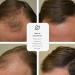 Delta Hair Regrowth Spray - All-Natural Alcohol-Free Minoxidil Solution for Hair Loss - Fast International Shipping - Buy Online on GoSupps.com